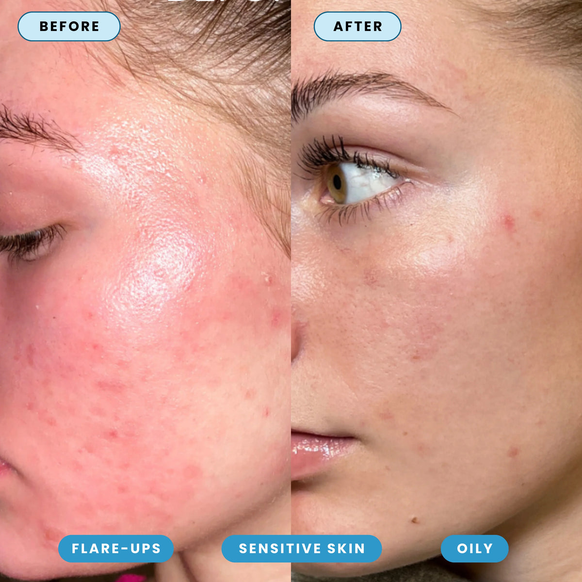 Hypochlorous Acid Spray - Cleanse & Soothe (200 ml)